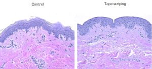 barrier function alteration. on skin explant